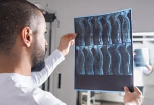 Spinal Cord Injury Lawsuit Loans | Tribeca Lawsuit Loans A doctor examines x-rays of the spinal cord.